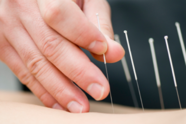 what is acupuncture?